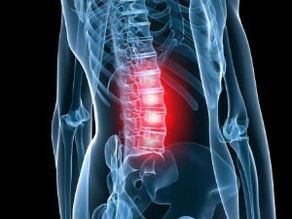 Lumbar ողնաշարի օստեոխոնդրոզ