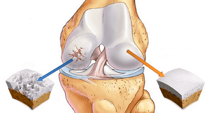 առողջ աճառ և արթրոզի ազդեցության տակ գտնվող աճառ